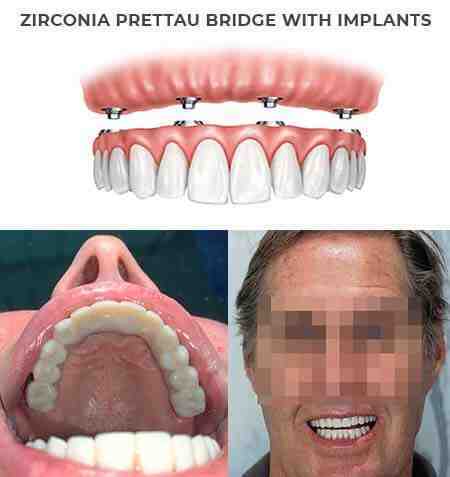 How much is a full top set of dental implants?
