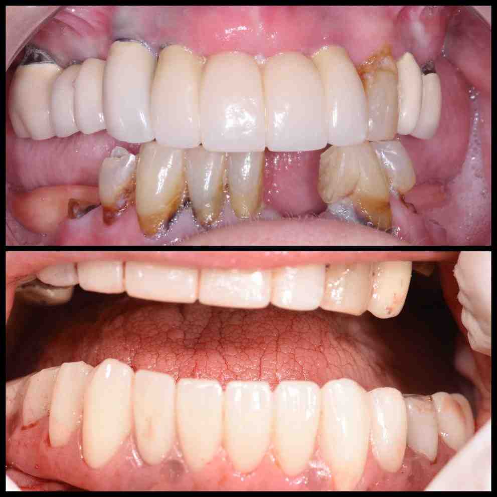 How much is a full top set of dental implants?
