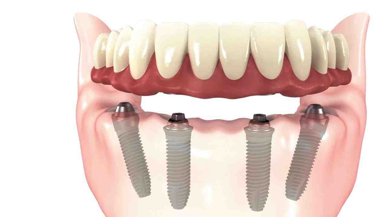 How much is a full top set of dental implants?