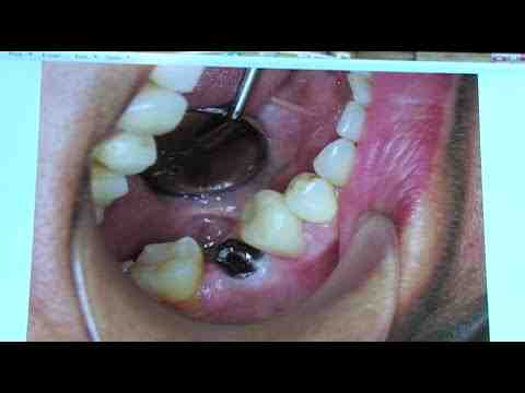 How much is a full top set of dental implants?