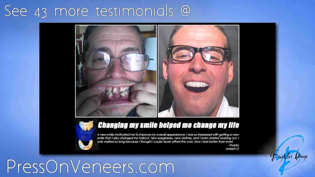 How much is a mouthful of dental implants?