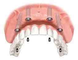 How much is a mouthful of dental implants?