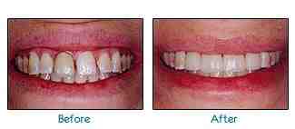 How much is a set of veneer teeth?