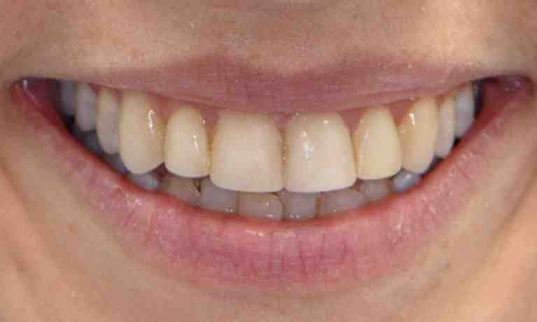 How much is a set of veneer teeth?