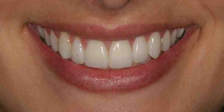 How much is cosmetic surgery for teeth?