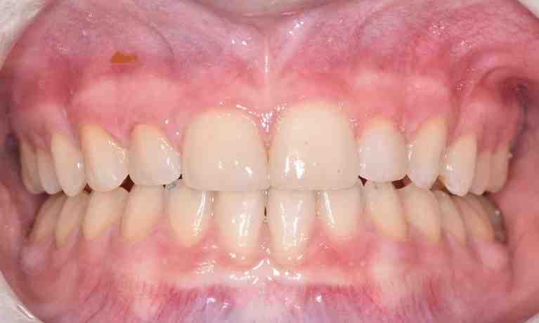 How much is cosmetic surgery for teeth?