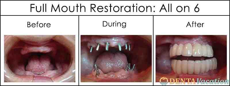How much is dental work in Costa Rica?