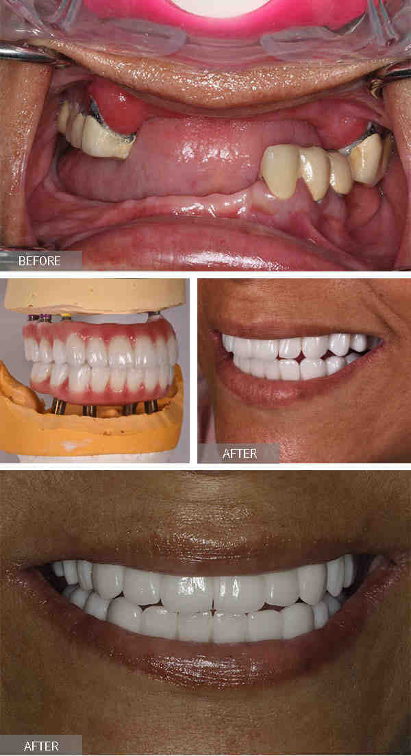 How much is the cheapest dental implant?