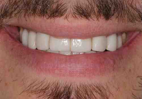 How much is the cheapest dental implants?