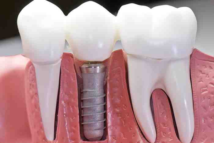 How much should dental implants cost in 2020?