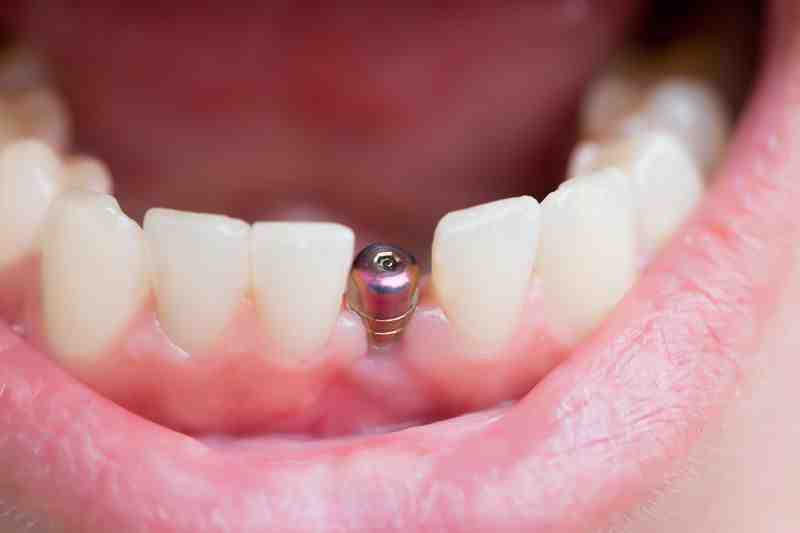 How much should dental implants cost in 2020?
