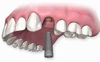 How much will dental implants cost in 2020?