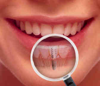 How painful is a dental implant?