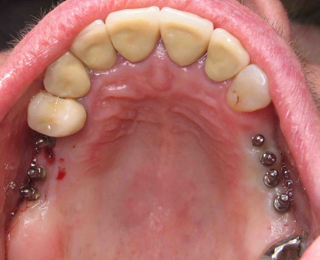 How bad does a dental implant hurt Dental News Network