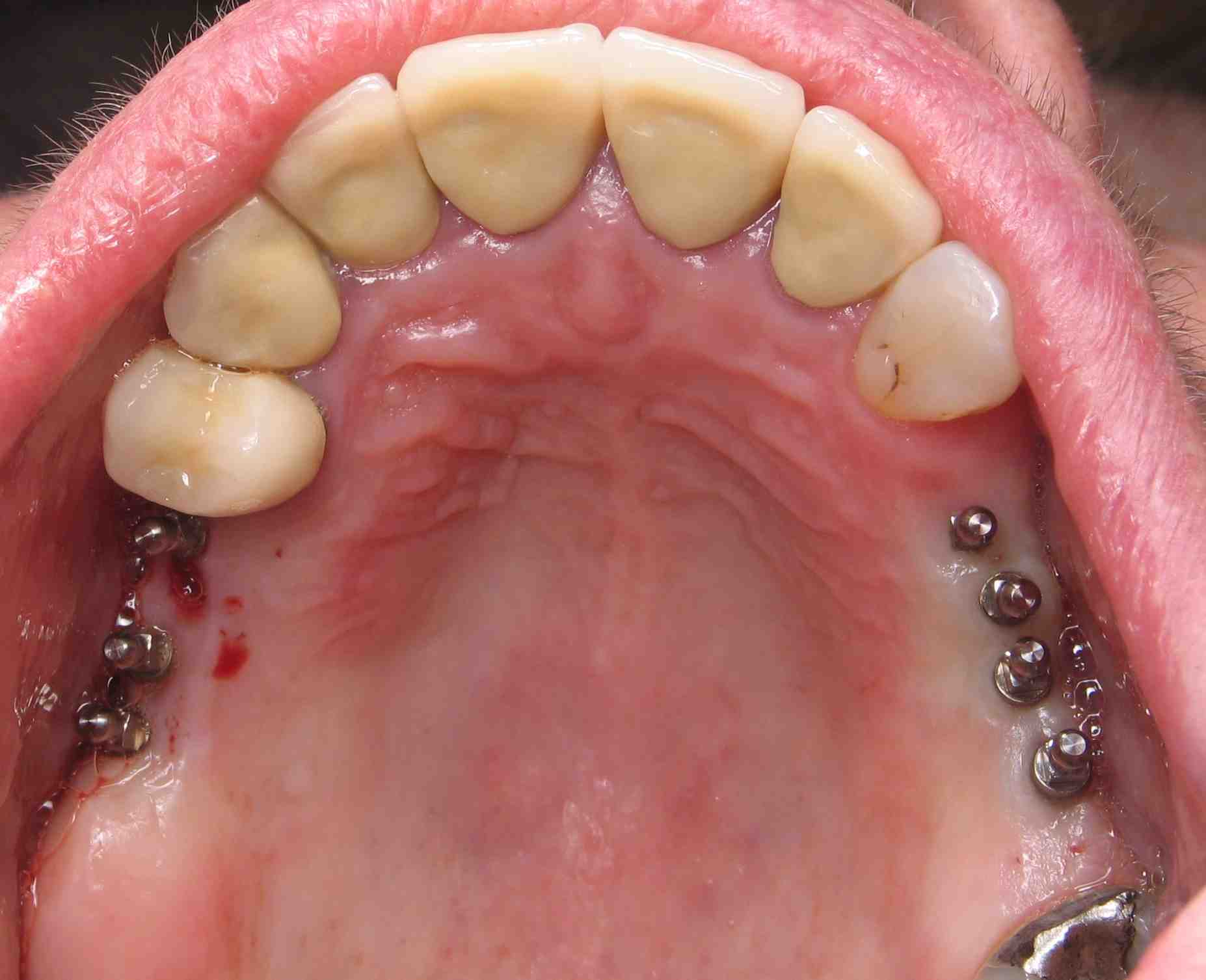 How bad does a dental implant hurt Dental News Network