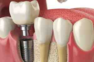 How painful is a dental implant?