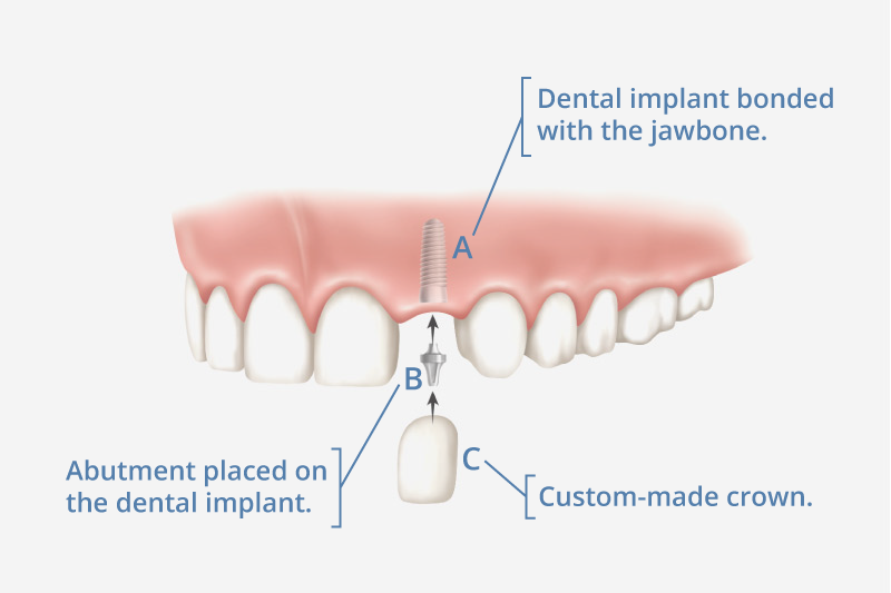 How painful is getting a dental implant?