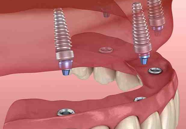 How to afford all on four dental implants