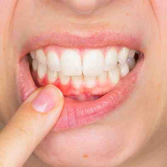 Is Methotrexate a contraindication for dental implants?