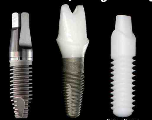 Is Titanium good for dental implants?