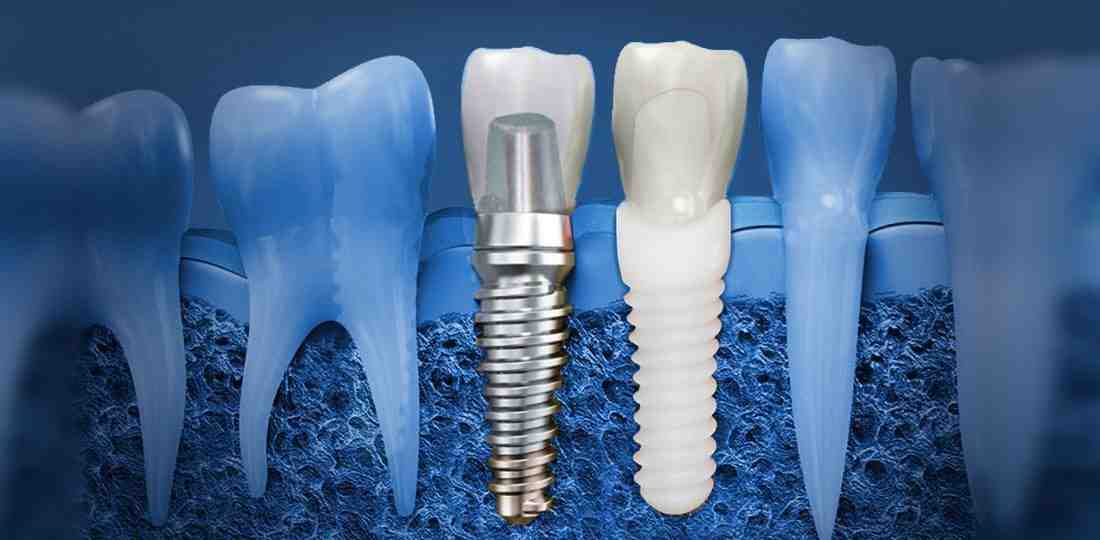 What to do if dental implant loose Dental News Network