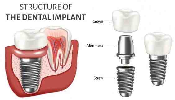 Is everyone suitable for dental implants?
