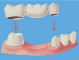 Is implant necessary for back molar?