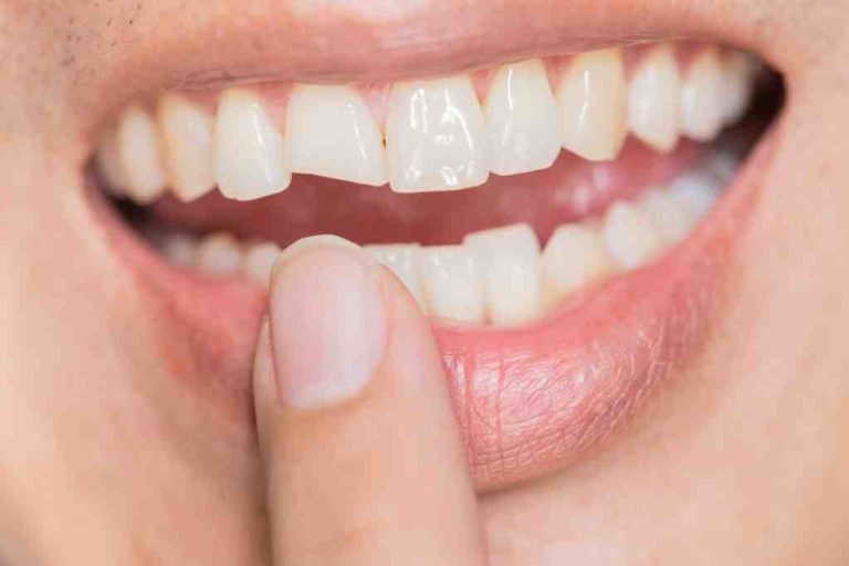 Cosmetic dentistry file down teeth Dental News Network