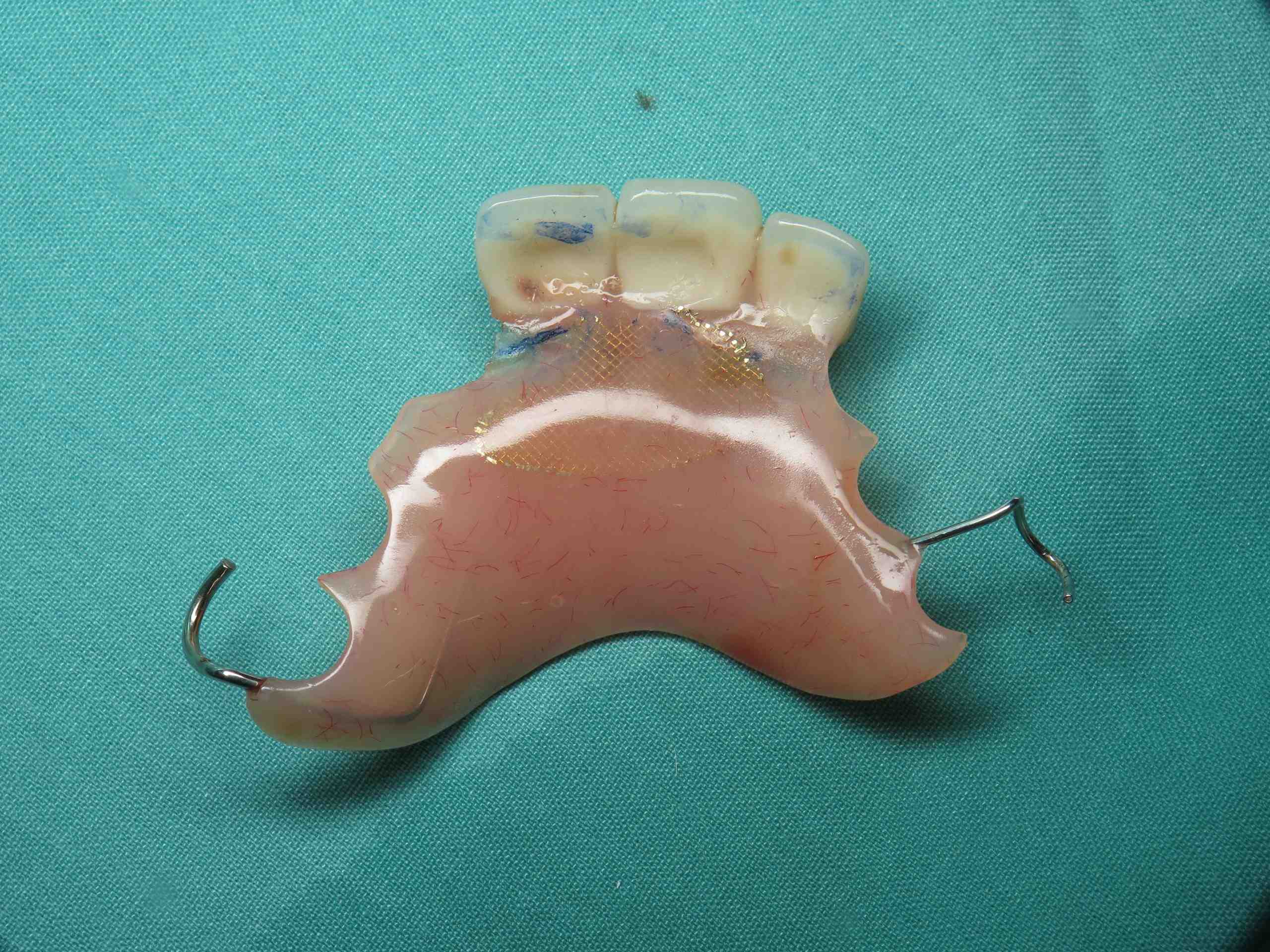 Is it ever too late to get dental implants?