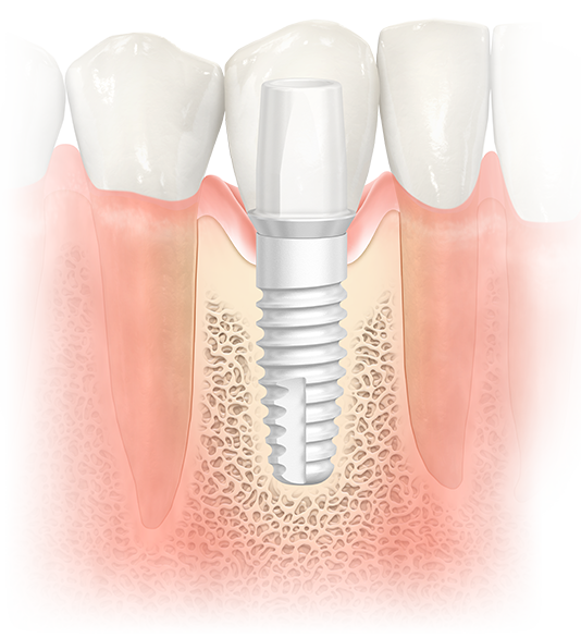 Where to get free dental implants Dental News Network