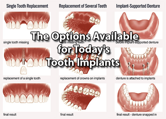 Is there a cheaper alternative to dental implants?