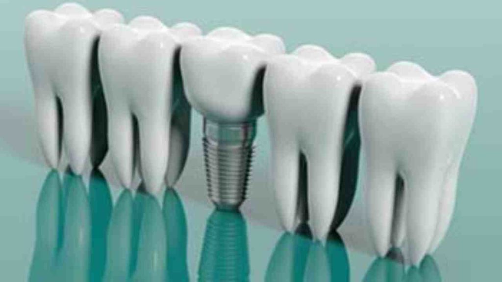 Is there a dental insurance that covers implants Dental