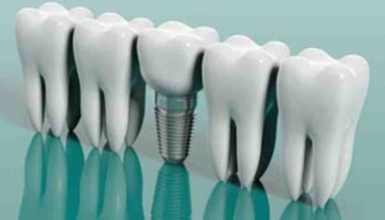 Is there a dental insurance that covers implants