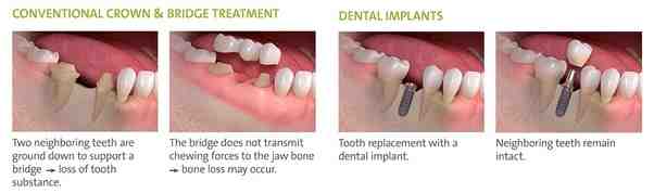 Is there an alternative to titanium implants?