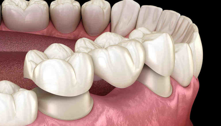 Is there an alternative use instead of titanium in dental implants