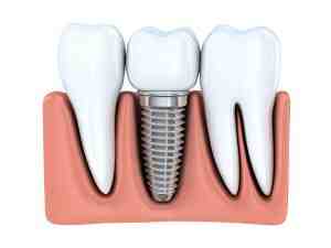 Does the va offer dental implants - Dental News Network