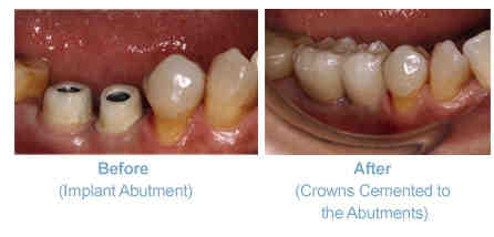 Should I be able to floss under my implant?
