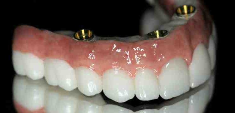 Should i floss around my new dental implant?