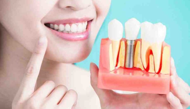 What are the alternatives to dental implants?