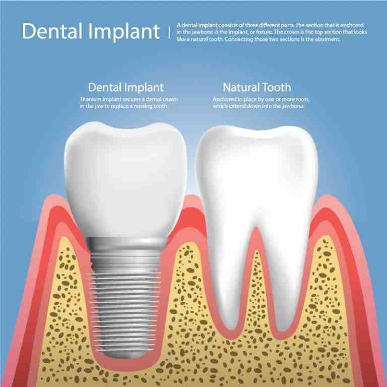 What are the different parts of a dental implant?