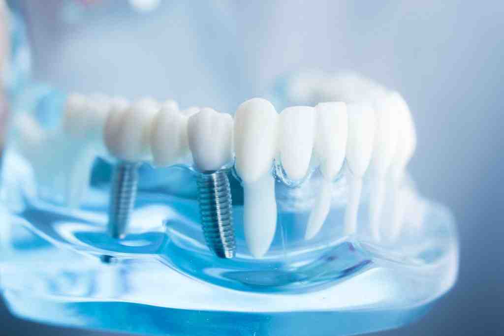 Are dental implants safe for the elderly - Dental News Network