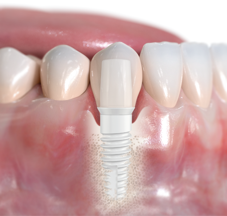 What are the negative effects of dental implants?