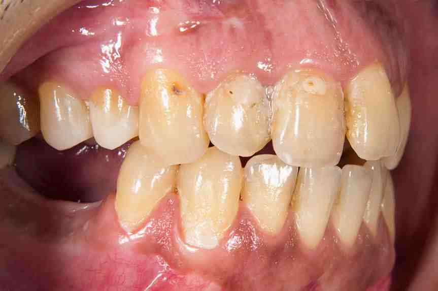What are the negative effects of dental implants?