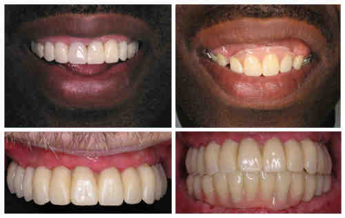 What are the negative effects of dental implants?