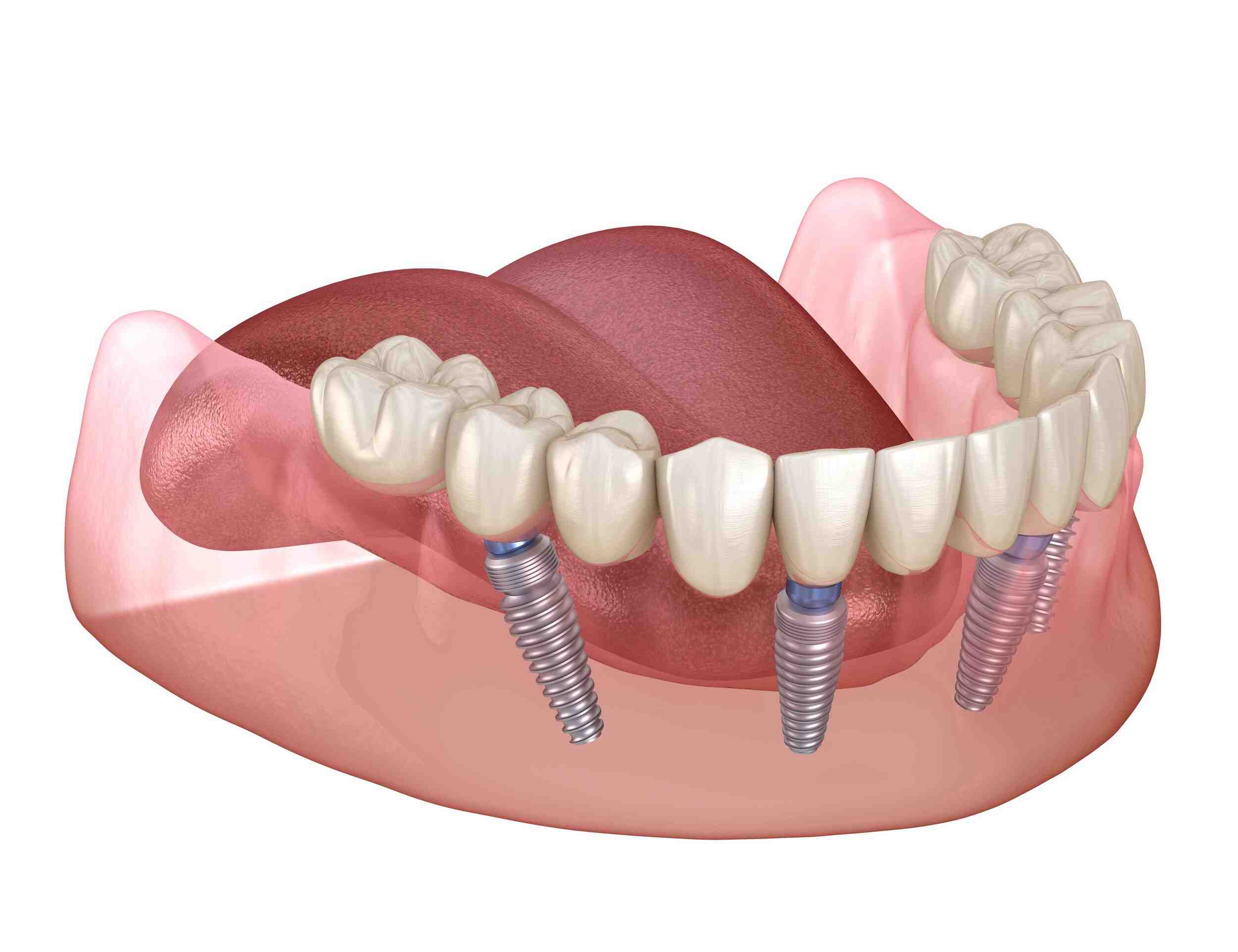 Does fsa cover dental implants Dental News Network
