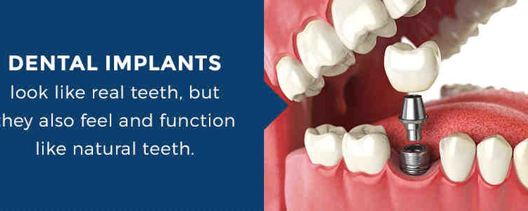 What do dental implants feel like