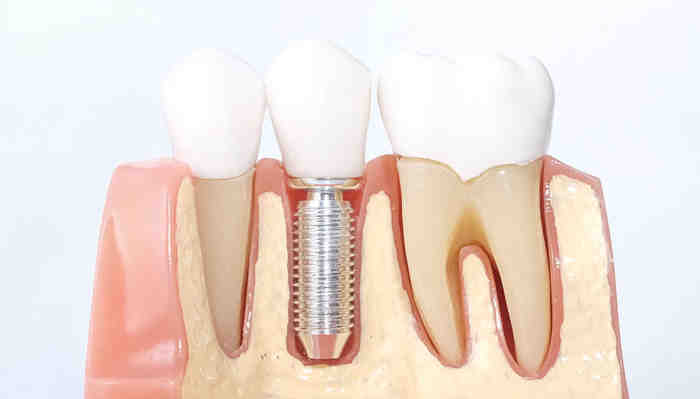 What do you do when an implant crown falls off?