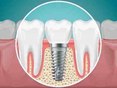 What does a dental implant look like?