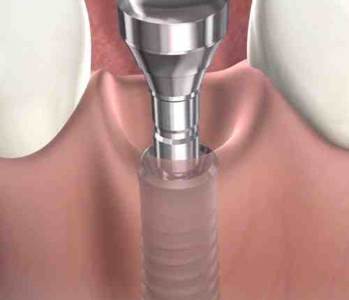 What does a titanium dental implant screw look like
