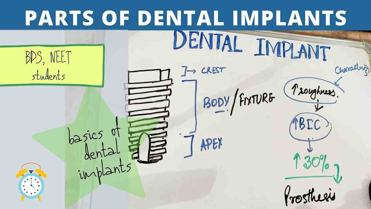 What does an implant consist of?